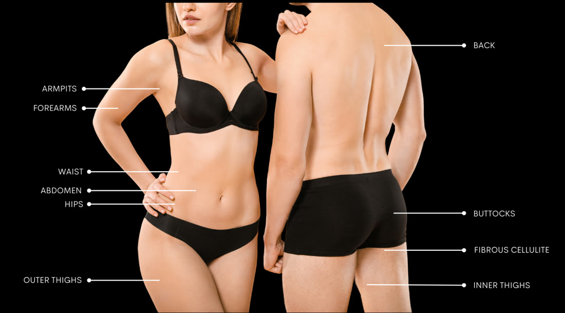 Diagram of LIPO 360 SHOT treatment areas: armpits, forearms, waist, abdomen, hips, outer thighs, inner thighs, back, buttocks and fibrous cellulite
